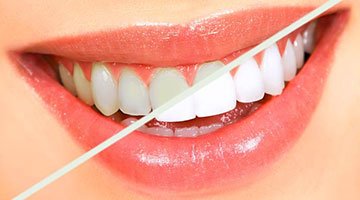 sbiancamento Sbiancamento denti Velletri